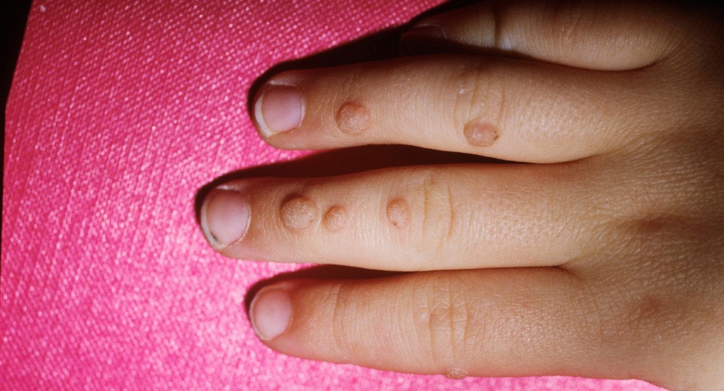 What Are Warts?